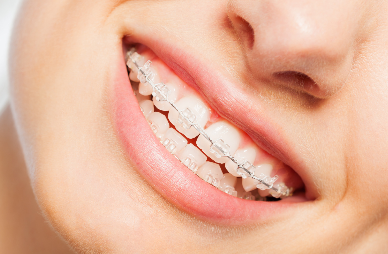 What Are Ceramic Braces, Exactly?