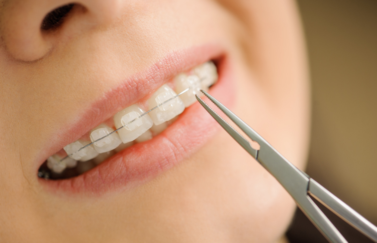 Ceramic Braces