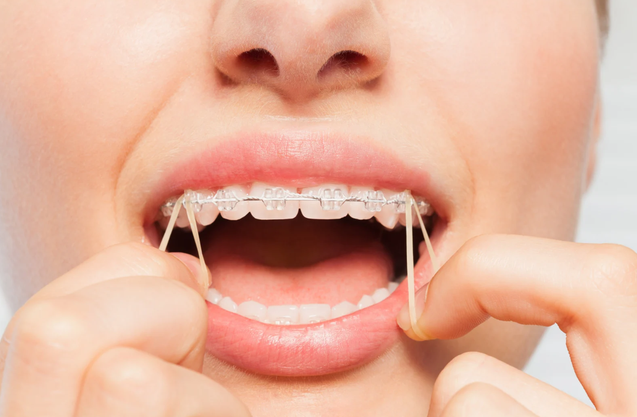 What Is Phase 1 Orthodontic Treatment?
