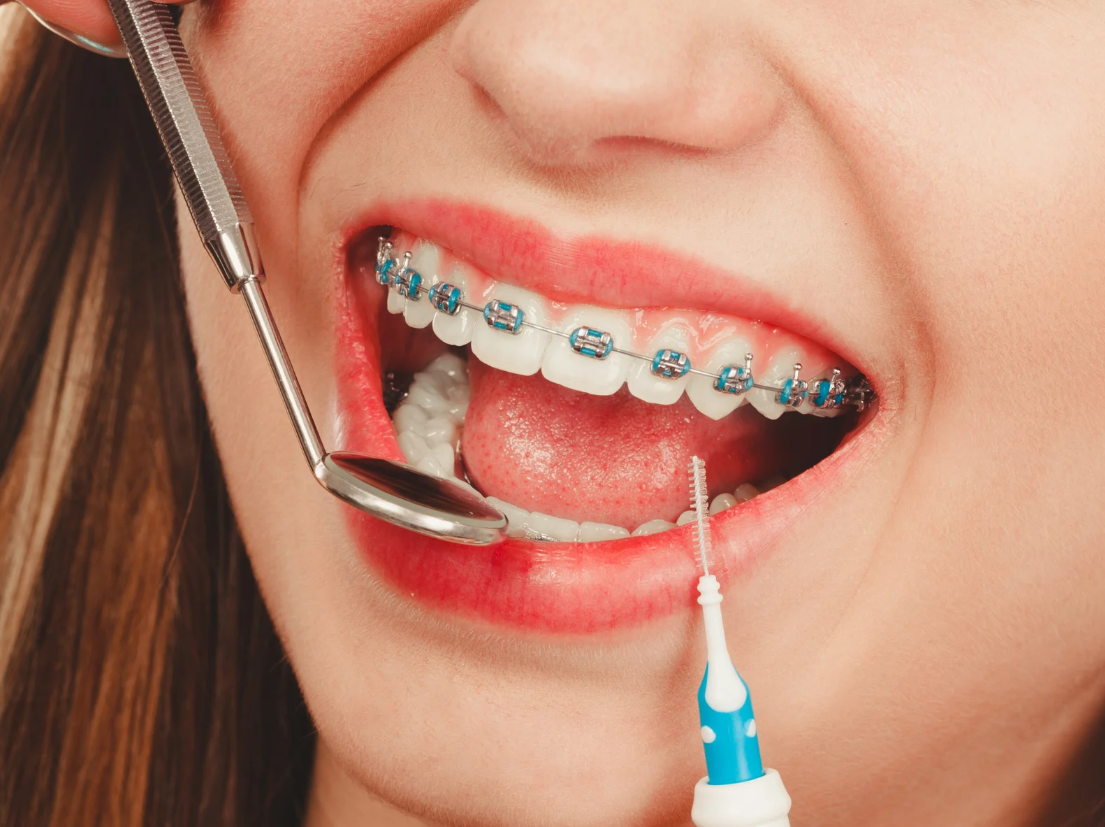 How Much Do Braces Cost in Hixson, TN?