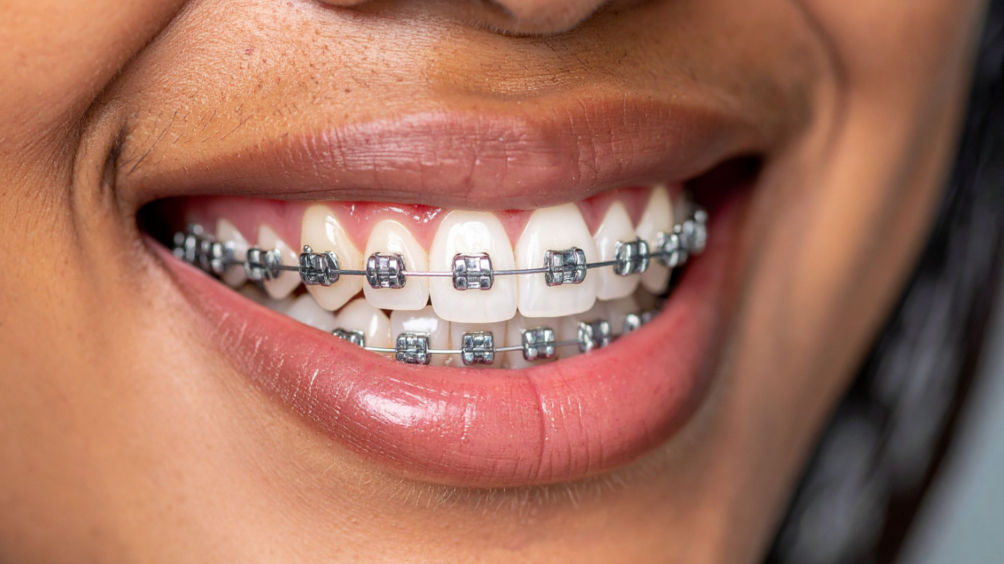 What Factors Affect the Price of Braces?