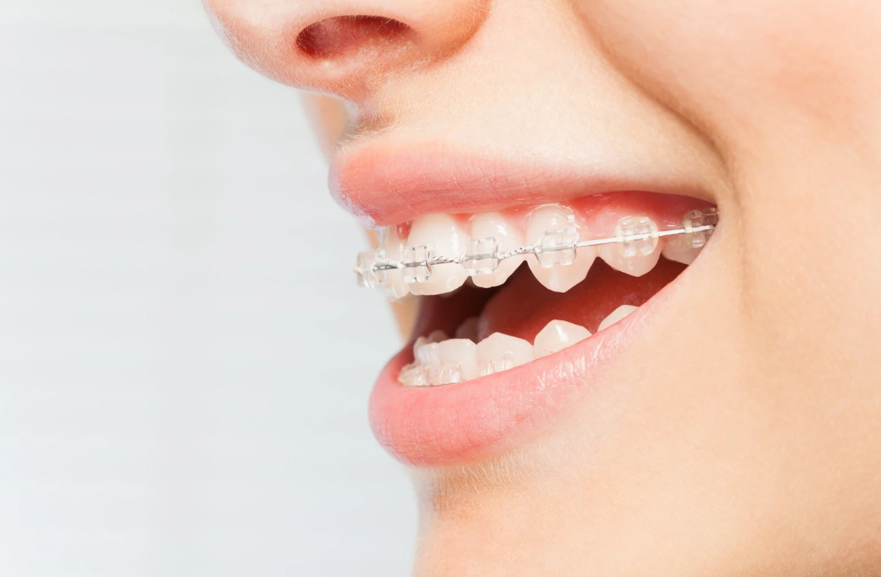 How Much Do Braces Cost in Northshore Chattanooga?