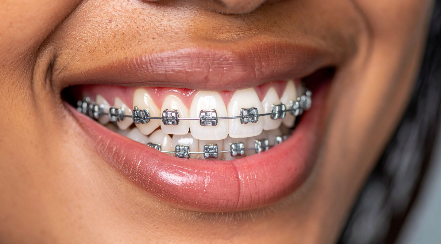 What Factors Affect Braces Cost?