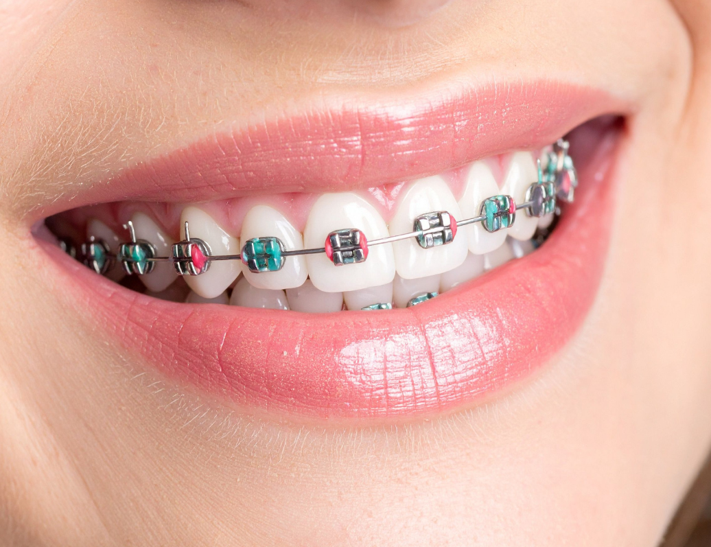 How Much Do Braces Cost in Chattanooga, TN?