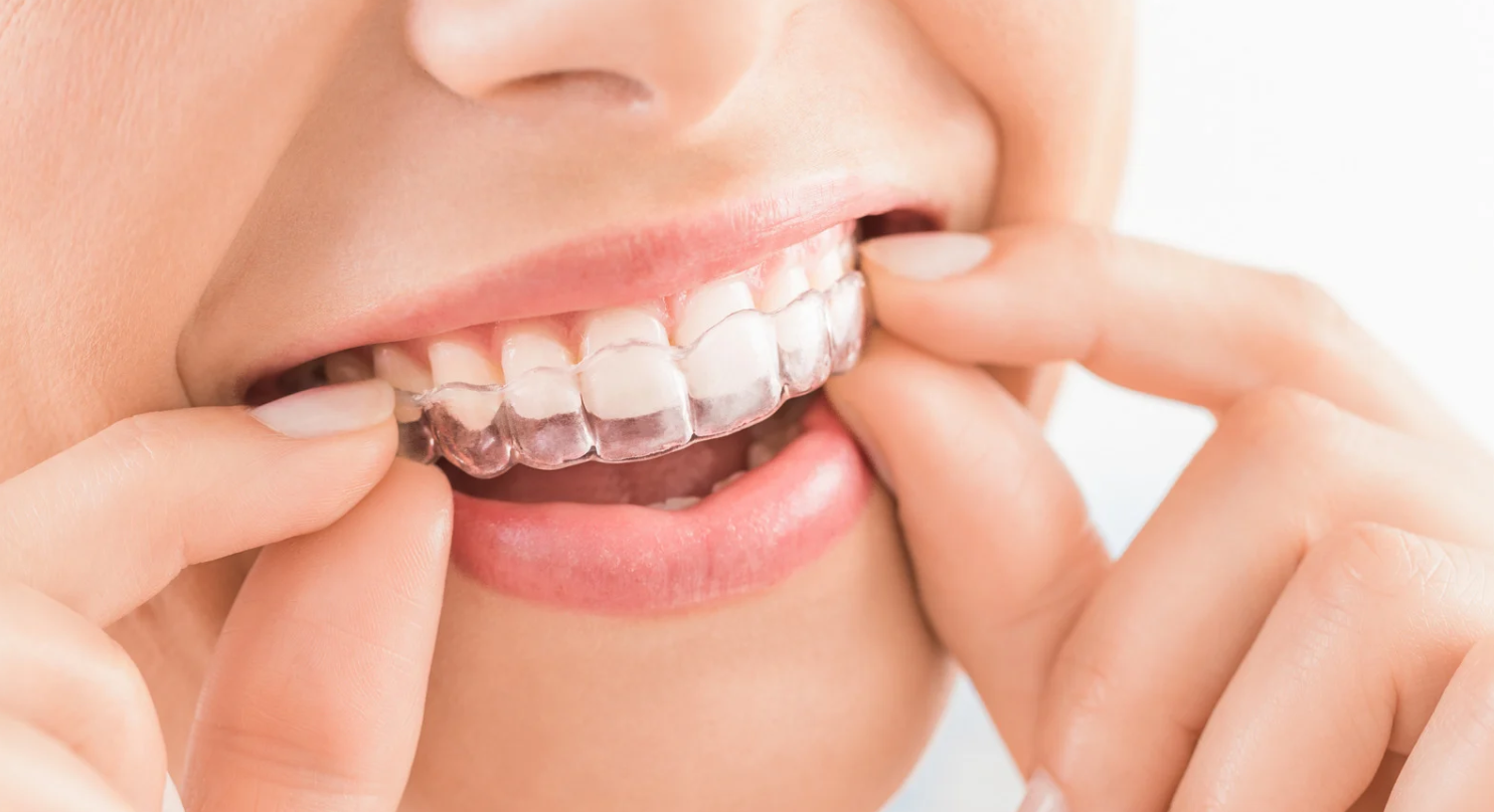 Invisalign in Dayton, TN: Cost and Treatment Options!