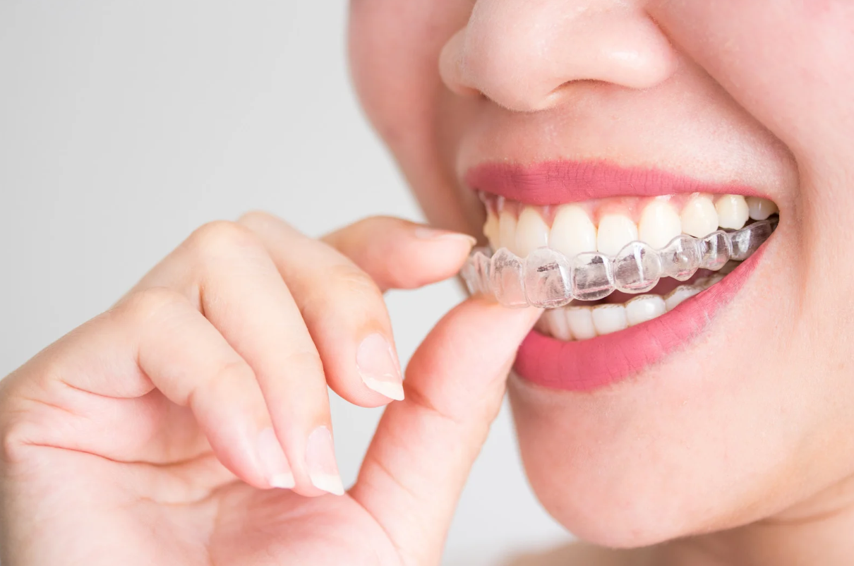 An Invisalign Consultation Confirms Your Exact Cost