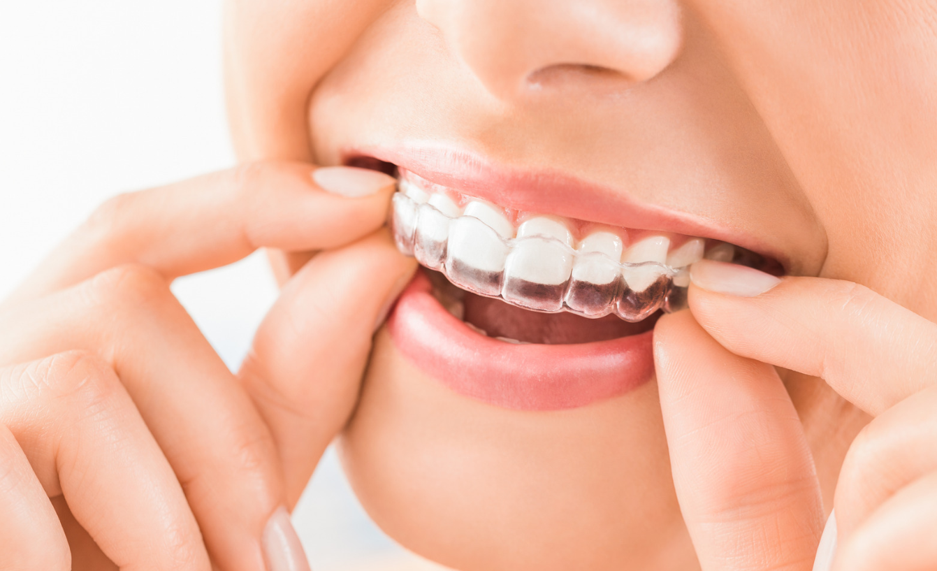 What Invisalign Treatment Options Are Available?
