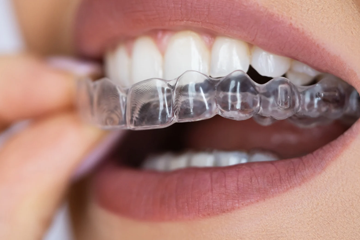 Invisalign in Soddy Daisy